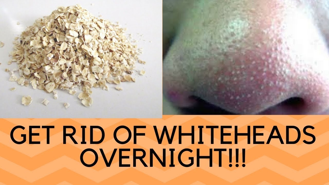 Video thumbnail for How To Remove Tons Of Blackheads & Whiteheads Instantly! Home Remedies