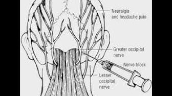 Video thumbnail for Occipital nerve injection for acute Migraine therapy #shorts