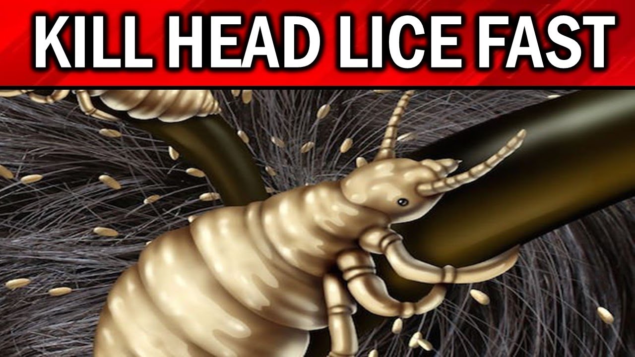 video of: How to Get Rid of HEAD LICE Fast, Naturally &amp; Permanently