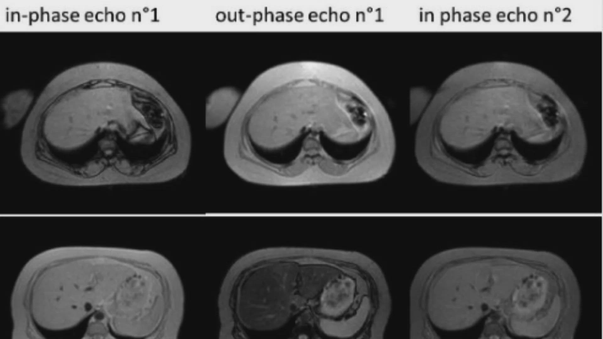 'Video thumbnail for Non-alcoholic Fatty Liver Disease (NAFLD)'
