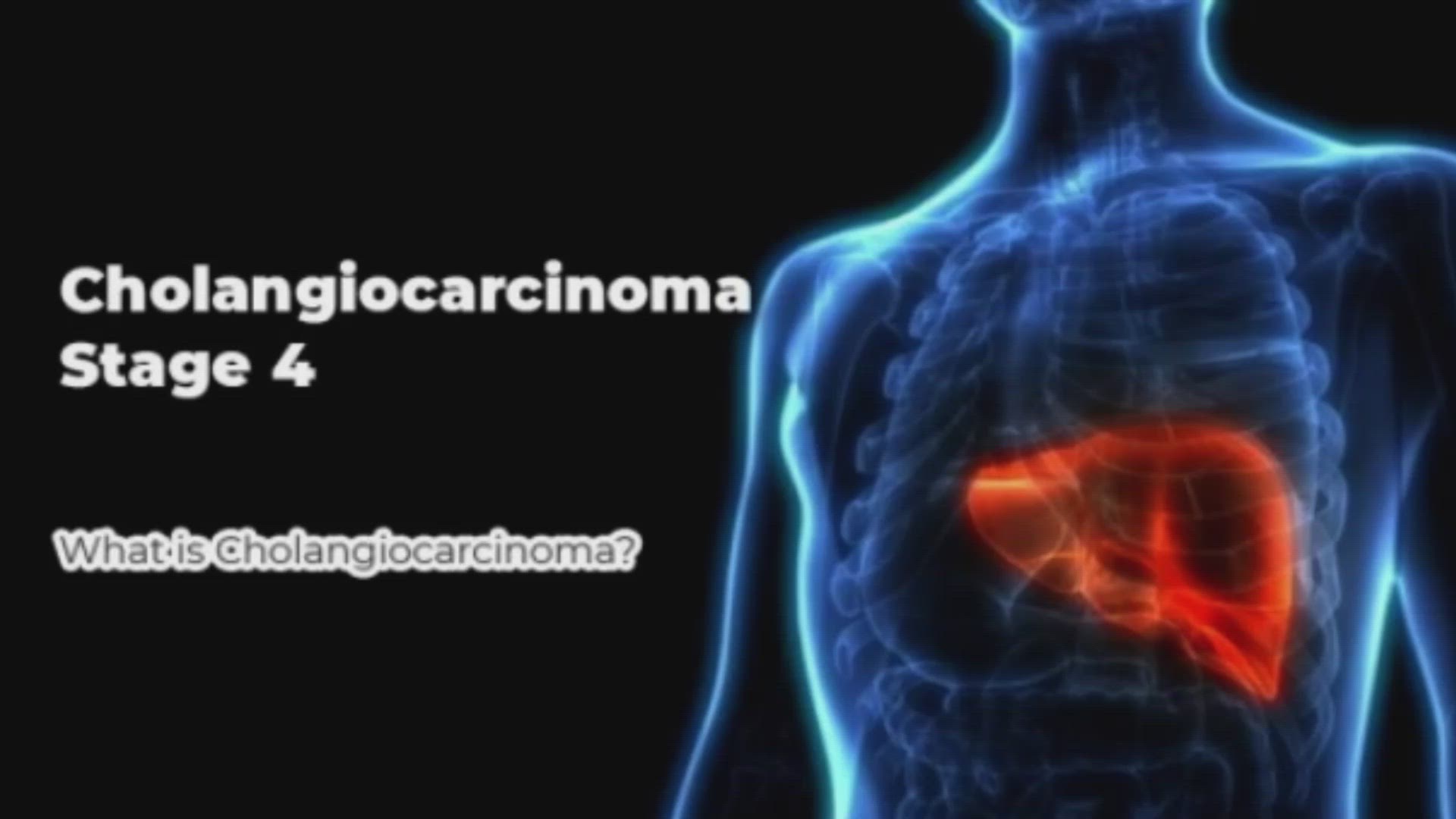 'Video thumbnail for Cholangiocarcinoma Final Stage'