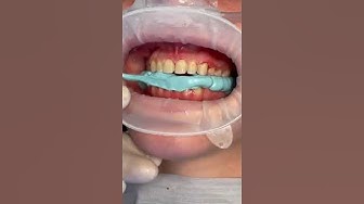 'Video thumbnail for #shorts #cleaning 😁#veneers #braces #implant #dental #dentist #shortvideo whats 😱😱'
