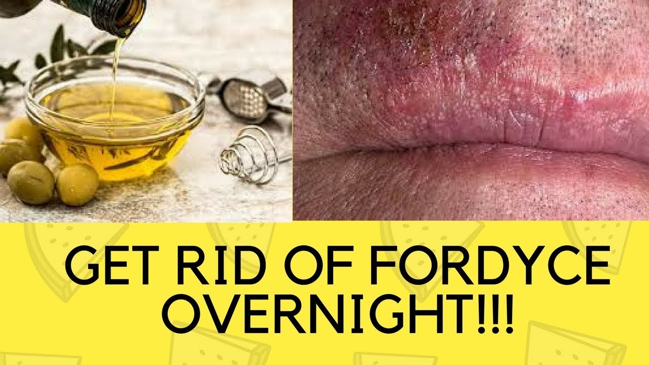 Video thumbnail for How To Get Rid Of Fordyce Spots On Lips And Shaft Overnight Naturally Fast At Home