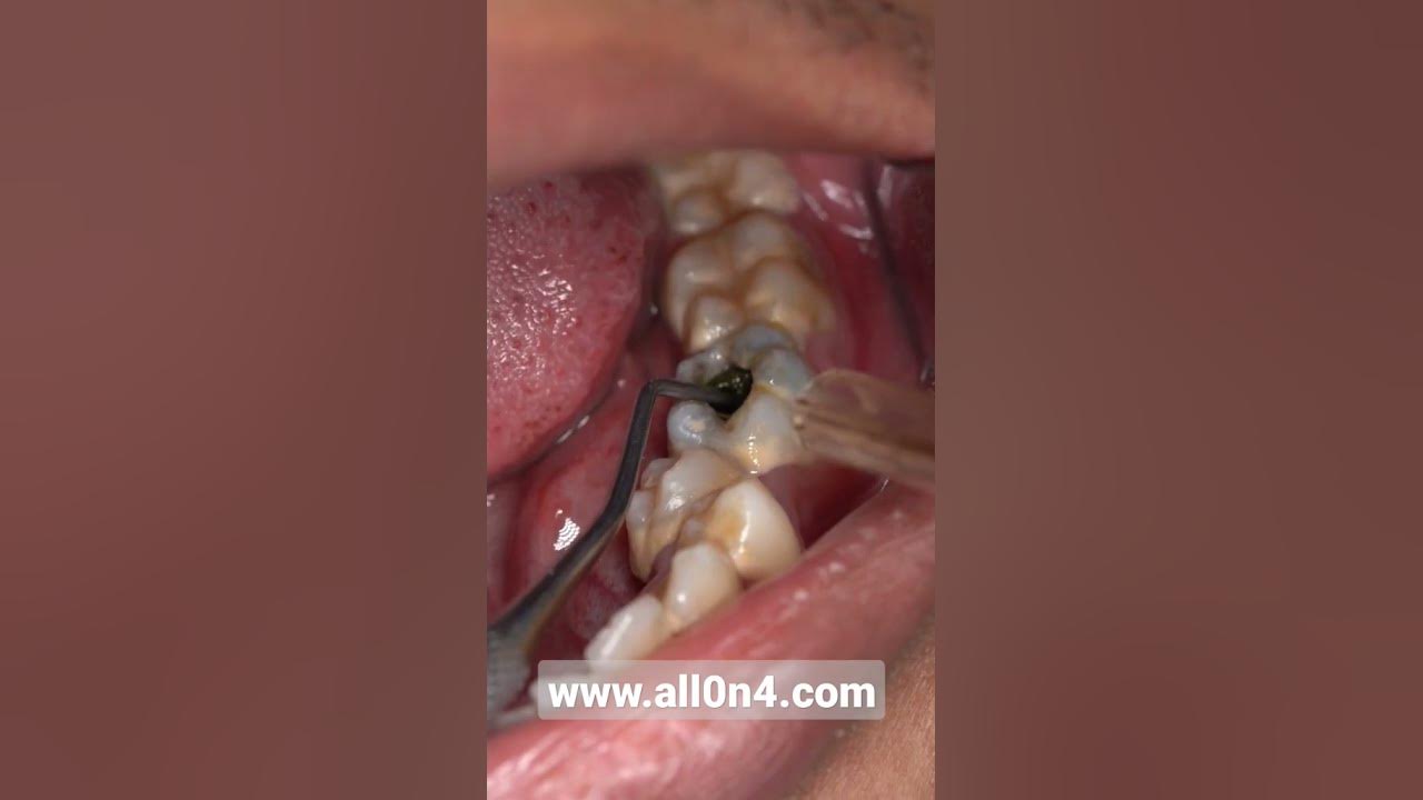 'Video thumbnail for #dental #cleaning #shorts 😱😁#braces #veneers #scaling #doktergigi #dentist #satisfyingvideos'