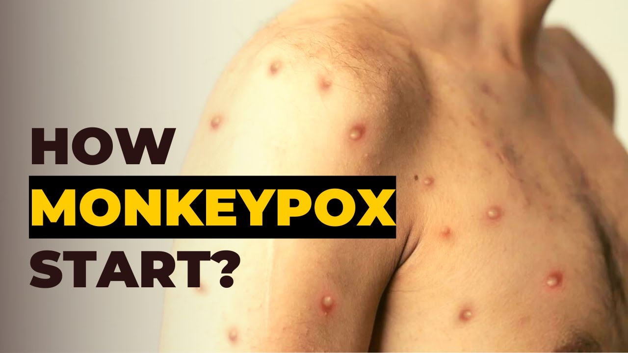 'Video thumbnail for Where did Monkeypox Come From - History of Monkeypox Outbreak'