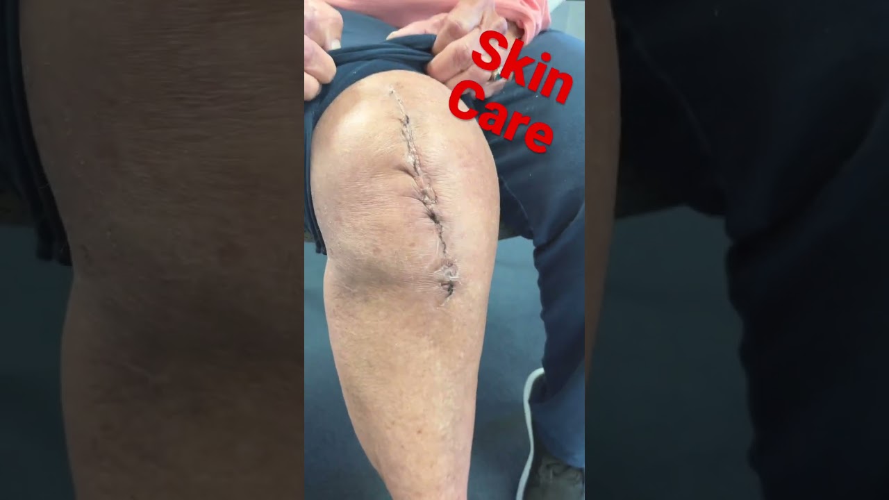Video thumbnail for Knee Replacement Skin Care