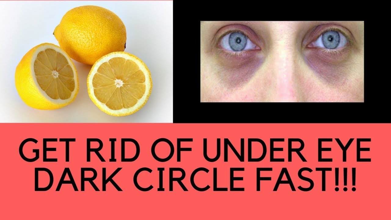 Video thumbnail for How To Get Rid Of Dark Circles Under Eyes Permanently Fast - Remove Dark Circles Naturally Overnight