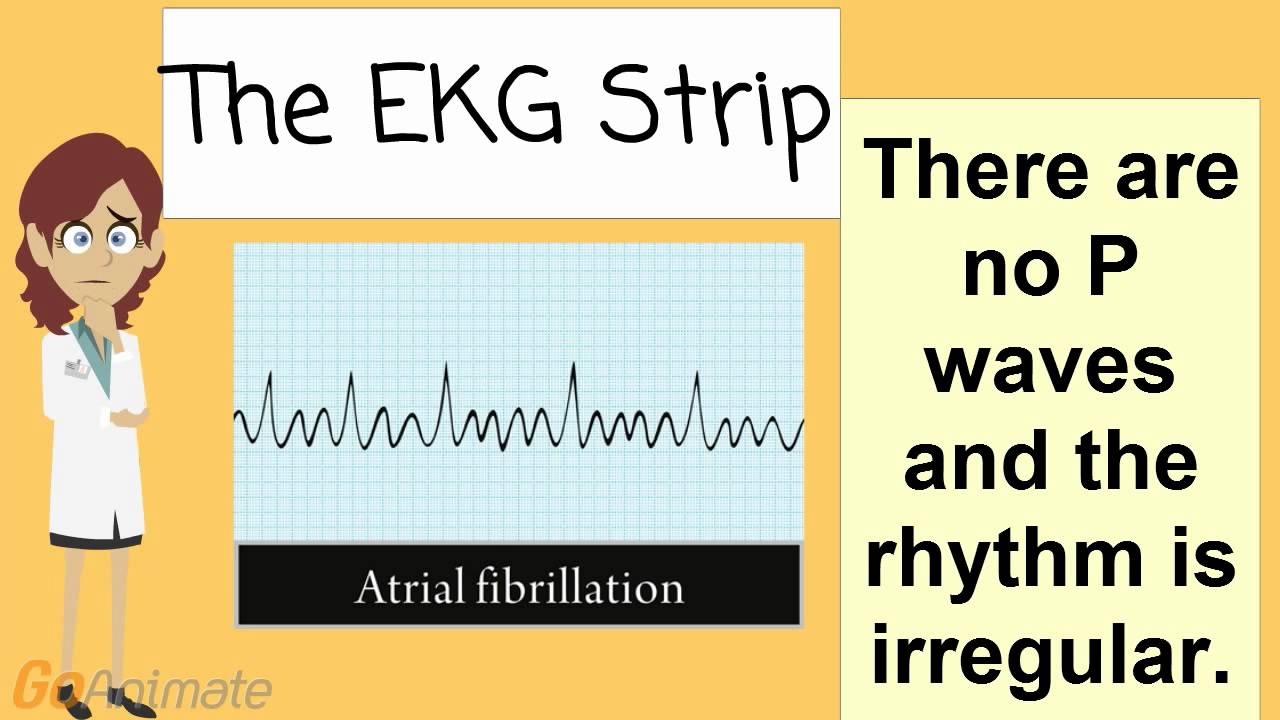 'Video thumbnail for What is Atrial Fibrillation'