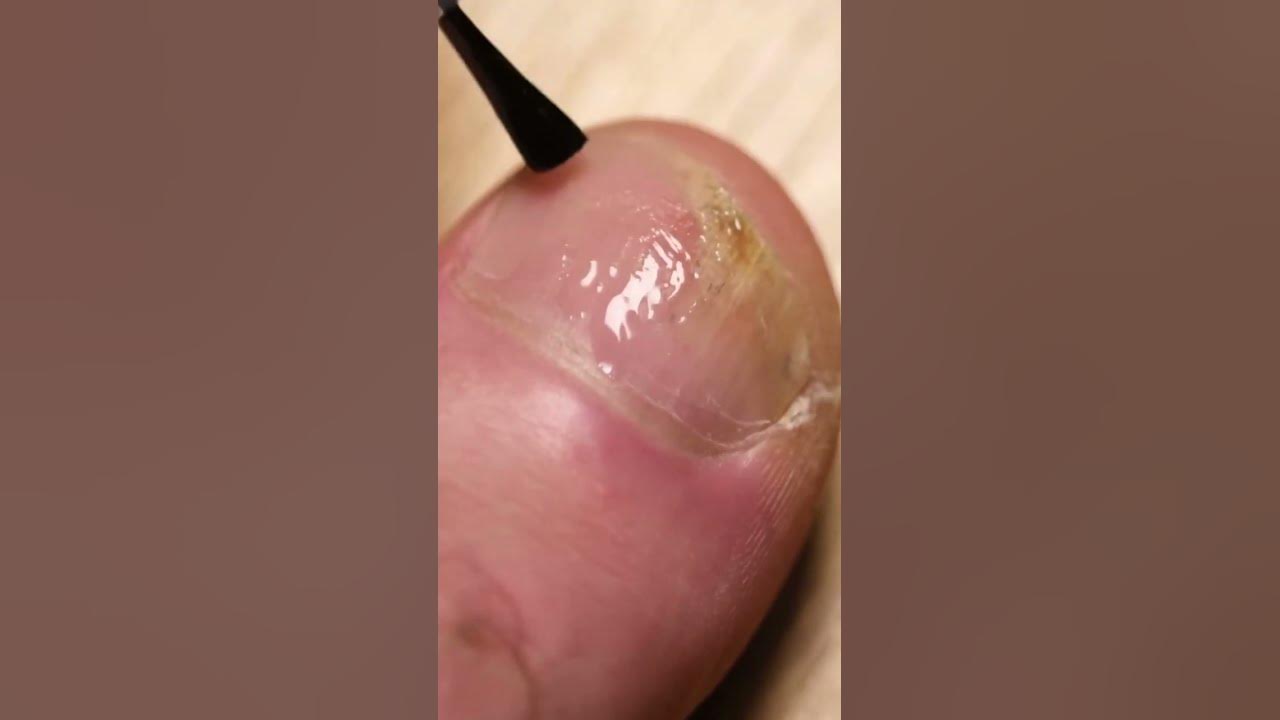 'Video thumbnail for Fungi Among Us: The Best Treatments for Toes Fungus #shorts'