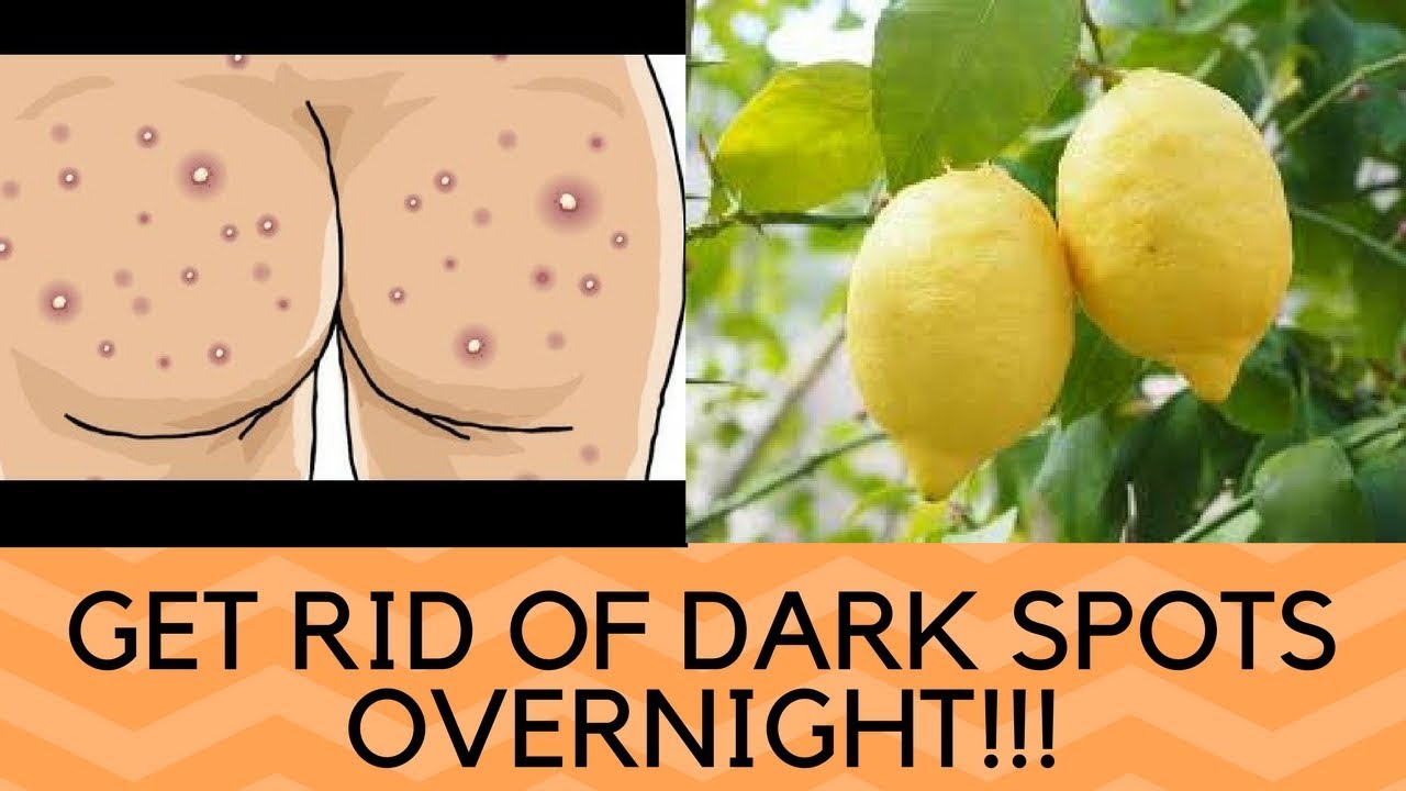 Video thumbnail for HOW TO GET RID OF DARK SPOTS ON THE BUTTOCKS OVERNIGHT NATURALLY - HOME REMEDIES FOR DARK SPOTS