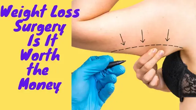 'Video thumbnail for Weight Loss Surgery Is It Worth the Money?'