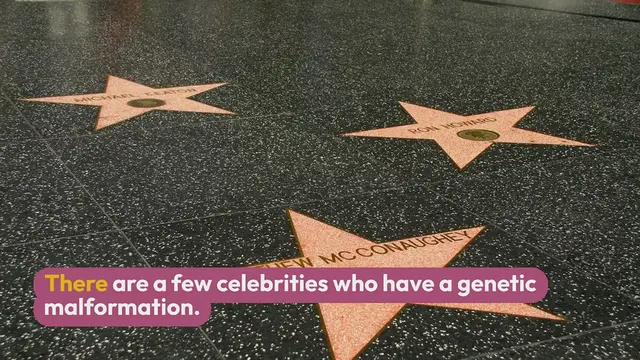 'Video thumbnail for Is there a celebrity who has a genetic malformation?'
