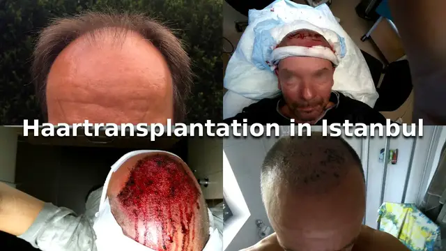 'Video thumbnail for Haartransplantation - die ersten 2 Wochen'