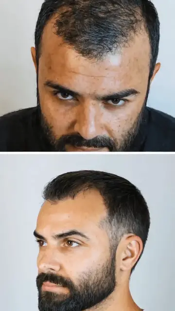 'Video thumbnail for Haartransplantation in Mannheim: Moderne Lösungen für Haarausfall'