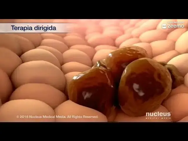 'Video thumbnail for Cáncer de mama'