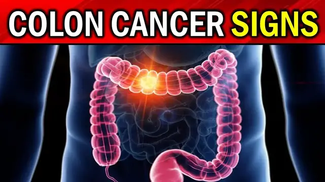 'Video thumbnail for 7 Early Warning Signs of Colon Cancer YOU SHOULD NOT IGNORE'