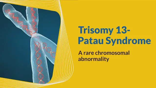 'Video thumbnail for Trisomy 13- a rare genetic condition'