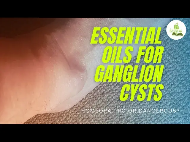 'Video thumbnail for Essential Oils for Ganglion Cysts - Homeopathic or Dangerous?'