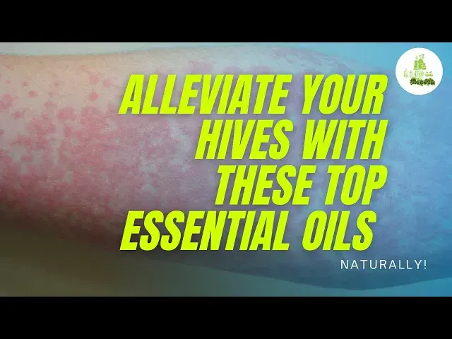 'Video thumbnail for Alleviate your Hives with These Top Essential Oils - NATURALLY!'