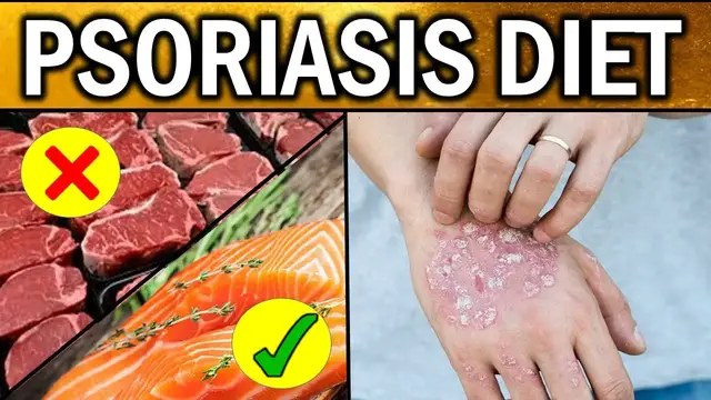 'Video thumbnail for 5 Best and Worst Foods for Psoriasis | Psoriasis Treatment and Diet: Foods to Eat and Avoid'