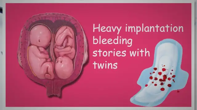 'Video thumbnail for Heavy implantation bleeding twins Stories'