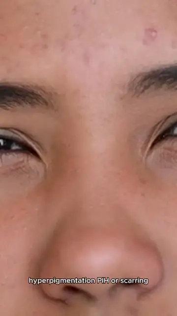'Video thumbnail for tips for acne mark removal'