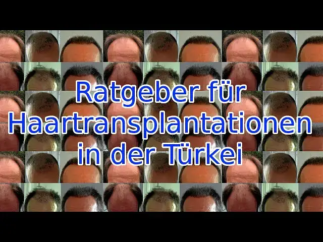 'Video thumbnail for Ratgeber für Haartransplantationen'
