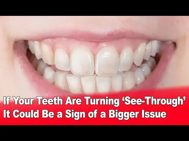 'Video thumbnail for If Your Teeth Are Turning ‘See-Through’ It Could Be a Sign of a Bigger Issue 🦷⚠️'
