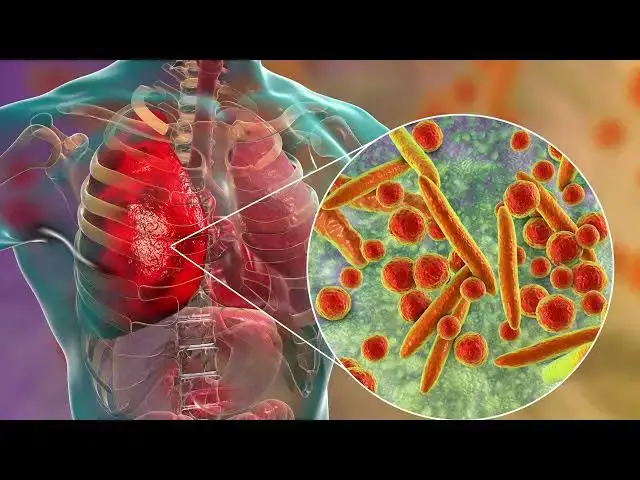 'Video thumbnail for Pneumonia Symptoms: A Guide to Identifying and Managing This Serious Illness'