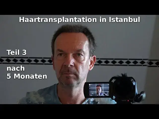 'Video thumbnail for Haartransplantation in Istanbul (3) nach 5 Monaten'