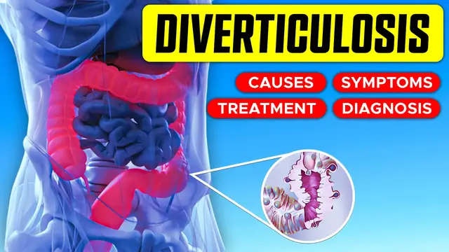 'Video thumbnail for 🔍🌿 Diverticulosis - Symptoms, Causes, Diagnosis, Treatment 🩺💊'