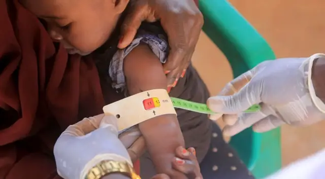 'Video thumbnail for US aid cuts leave Somali children at risk as malnutrition and disease surge'