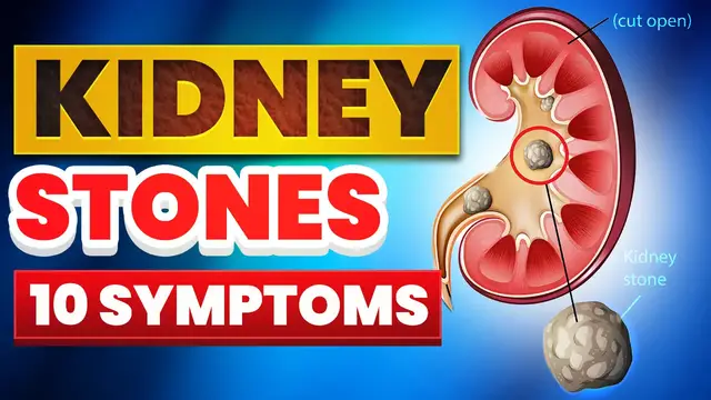 'Video thumbnail for ⚡ 10 Signs of Kidney Stones (Don't Ignore)'