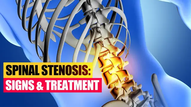 'Video thumbnail for 🦴 Symptoms of Spinal Stenosis'