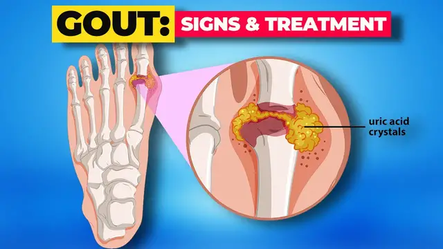 'Video thumbnail for Gout: Symptoms, Causes, Diagnosis & Treatment'