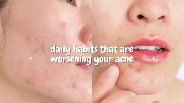 'Video thumbnail for These Bad Habits Are Making Your Acne Worse – Stop Them NOW!'