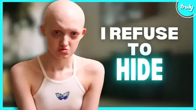 'Video thumbnail for My Rare Condition Took My Hair & Teeth | BORN DIFFERENT'