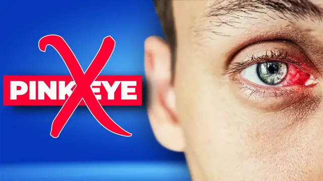 'Video thumbnail for 🔴 How to Get Rid of Pink Eye'