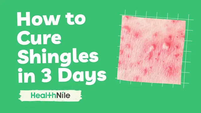'Video thumbnail for How to Cure Shingles in 3 Days'