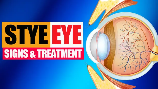 'Video thumbnail for 👁️ Stye Eye: Signs & Treatment'
