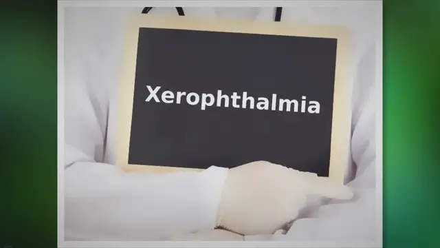 'Video thumbnail for What is xerophthalmia & how is it treated? - An Eye Care Blog'