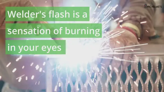 'Video thumbnail for Home Remedies To Treat Welder's Flash'