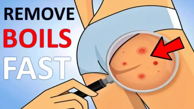 'Video thumbnail for How to Get Rid of Boils on the Buttocks? | 14 Home Remedies for Boils'