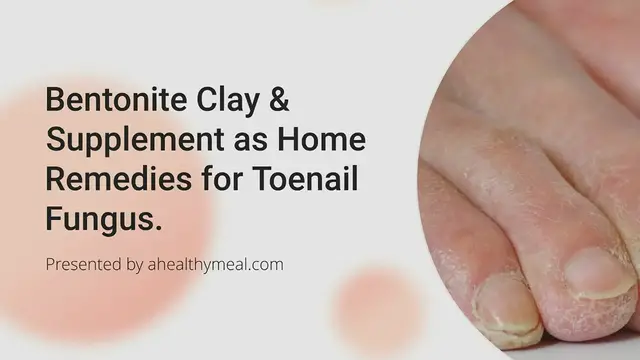 'Video thumbnail for Bentonite Clay & Supplement as Home Remedies for Toenail Fungus'
