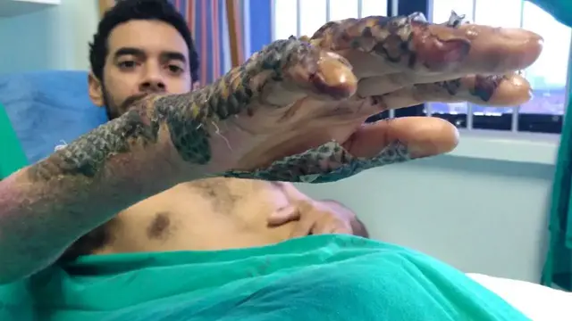 'Video thumbnail for Can tilapia skin be used to bandage burns?'