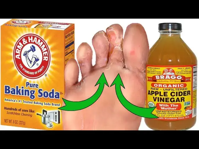 'Video thumbnail for Say Goodbye to Athlete's Foot Naturally: Baking Soda & Apple Cider Vinegar'
