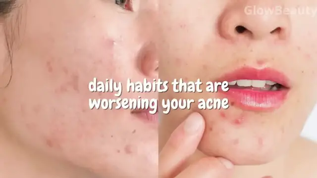 'Video thumbnail for acne | cystic acne | fungal acne | cerave acne control cleanser | acne scar treatment'