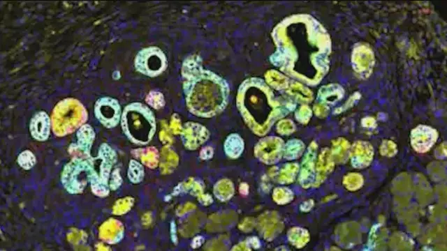 'Video thumbnail for LI scientists make pancreatic cancer breakthrough'