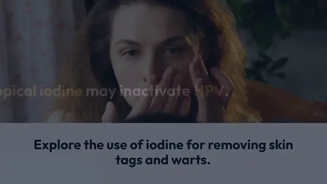 'Video thumbnail for Iodine Treatment for Skin Tags'