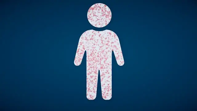 'Video thumbnail for What makes measles so contagious?'